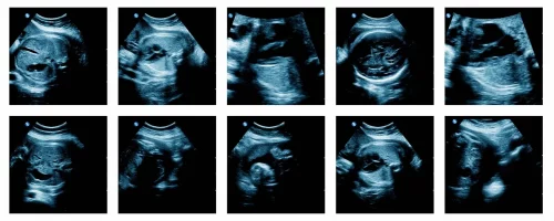 La fertilité des femmes baisse-t-elle vraiment à partir de 35 ans ?